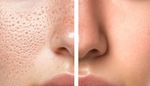 Non Surgical Enlarged Pore Treatment Guide: Benefits, Facts and Details